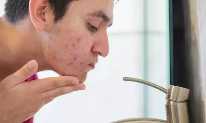 creatina causa espinhas ou dá acne